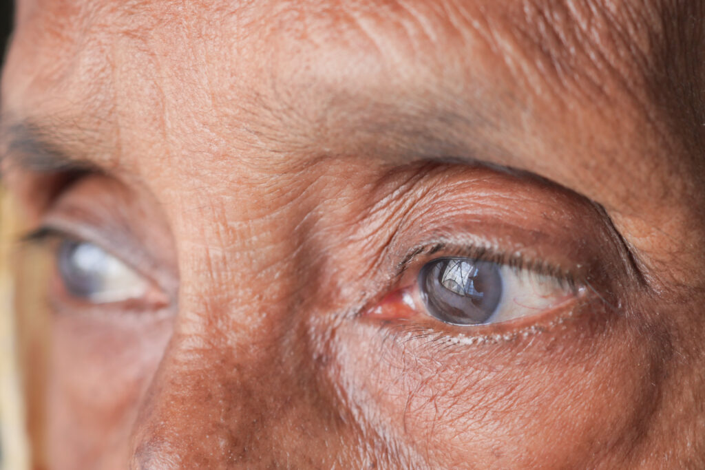 cataract surgery in Yelahanka